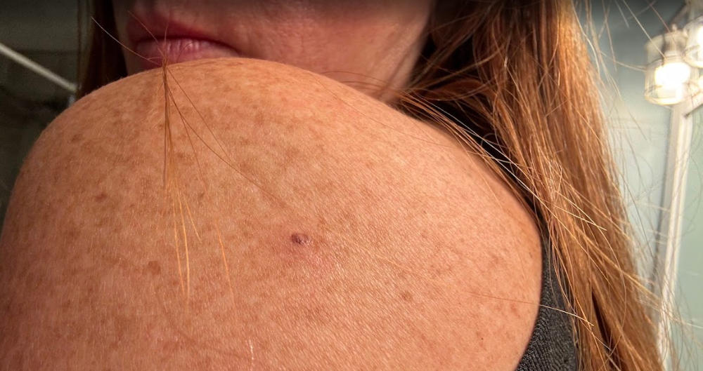 picture of shoulder with concerning spot for skin cancer